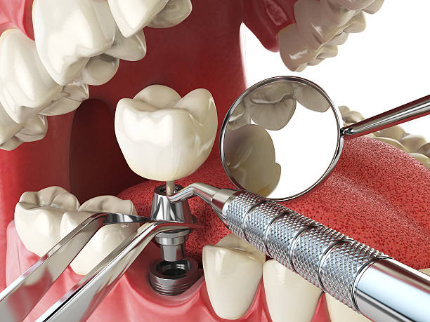 Best Emergency Tooth Extraction in Collinsville, MS